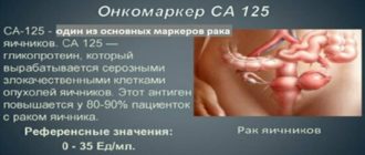 Онкомаркер СА125 при кисте