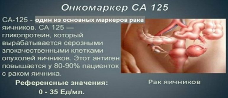 Онкомаркер СА125 при кисте