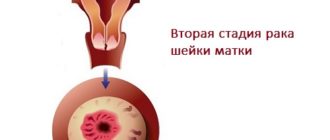 Гиповаскулярное образование на культе шейки матки