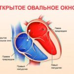 Нужно ли делать повторную флюрографию. Орви или сново пневмония