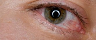 Новообразование во внешнем уголке глаза