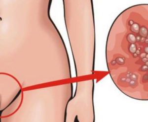 От уколов мильгаммы появляется генитальный герпес, почему?