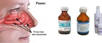 Перекись водорода попала в нос ребёнку