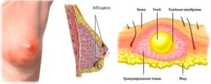 Гнойник под грудью