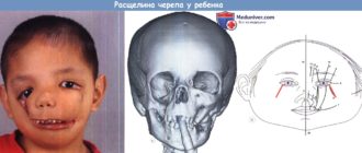 Перелом черепа у ребенка 6 ти месяцев