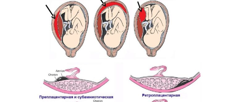 Отслойка плаценты