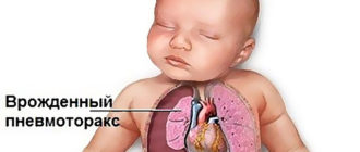 Нераскрытое легкое у ребенка