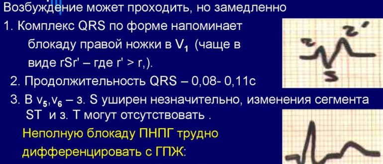 Неполная блокада правой ножки гиса