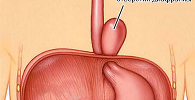 Грыжа пищеводного отверстия диафрагмы