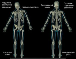 Одна нога короче другой на 0,5 см