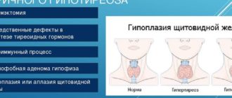 Гипоплазия щитовидной железы но гормоны в норме