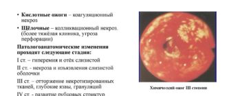 Ожог пищевода едой
