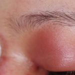 Откачивание жидкости при туберкулез