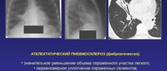 Фиброателектаз с очагами