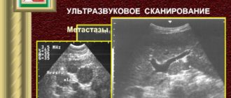 Печень новообразование в воротах печени