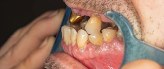 Гнилой запах после лечения