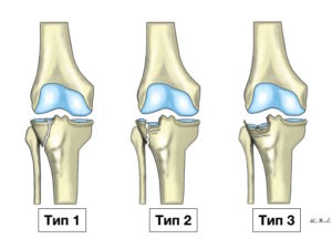 Перелом мыщелка большеберцевой кости
