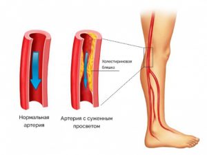 Облитерирующий атеросклероз сосудов нижних конечностей