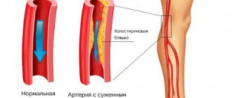 Облитерирующий атеросклероз сосудов нижних конечностей