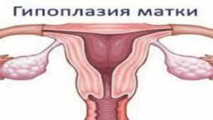 Гипоплазия матки, поликистоз яичников