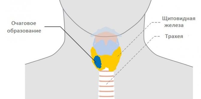 Очаговые изменения щитовидной железны