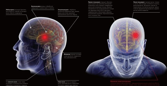 Головная боль правое полушарие