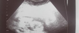 Гипертонус на 14 неделе