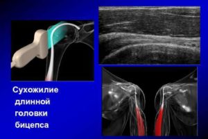 Отрыв длинной головки двуглавой мышцы плеча и ее сухожилие