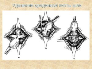 Операция срединная киста шеи