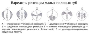 Необычная форма малых половых губ