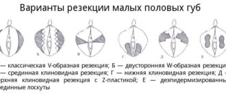 Необычная форма малых половых губ