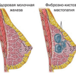 Гистероскопия при эндометриозе