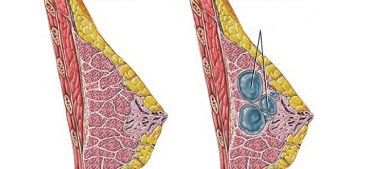 Фиброзно-кистозная мастопатия. Киста левой молочной железы. Эффективное лечение?