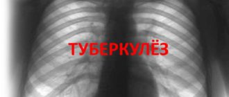 Флюрография плохая