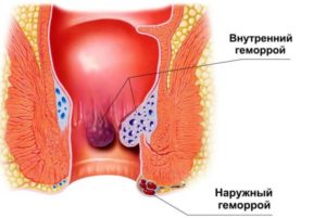 Образовалась шишка с черной точкой, наружный геморой