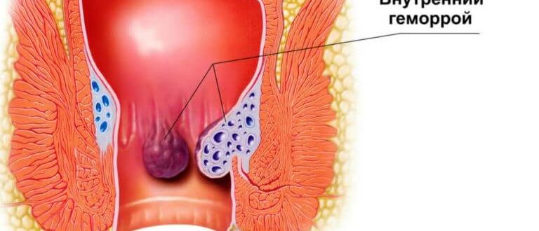 Образовалась шишка с черной точкой, наружный геморой