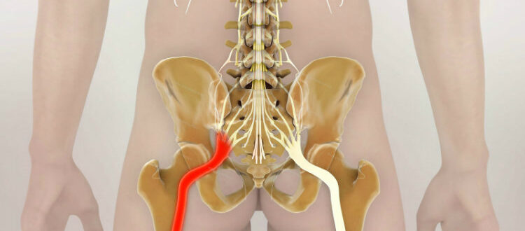 Невралгия седалищного нерва?