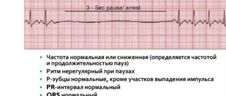 Паузы в сердечном ритме у ребенка