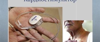 Отторжение кардиостимулятора