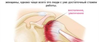 Ограниченная подвижность плеча