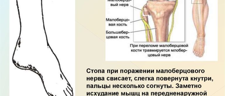 Онемела голень, неврит малоберцового нерва