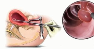 Гиперплазия эндометрия чистка