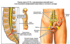 Грыжа l1-l2