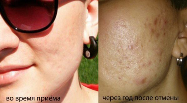 Отмена ок после длительного приема
