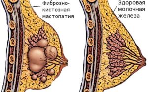 Фиброзно кистозная мастопатия