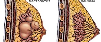 Фиброзно кистозная мастопатия