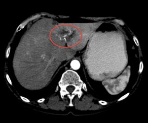 Образования в печени на кт