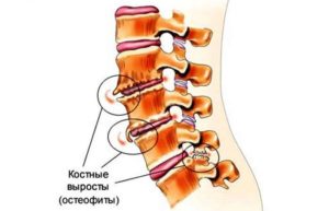 Остеохондроз, остеофиты на позвоночнике