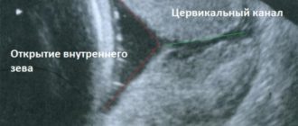 Открытие внутреннего зева на 28 неделе беременности