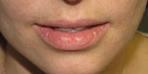 Грубые корочки на нижней губе